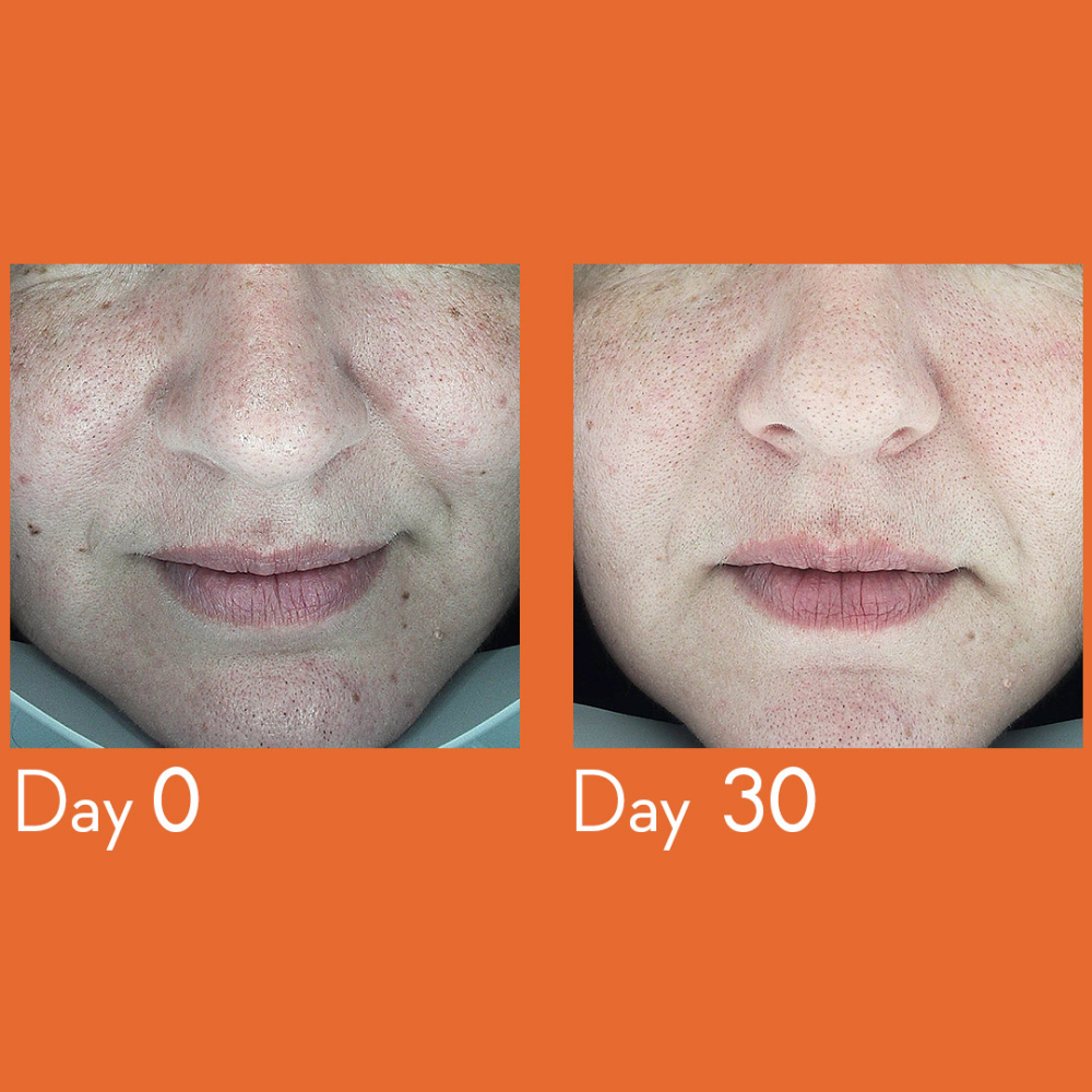 Dark spot remover serum 30 ml